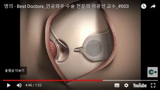 와우 임플란트 전