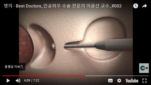 와우 임플란트 전