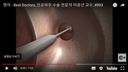 와우 임플란트 전