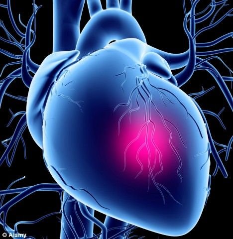 Myocardial infarction