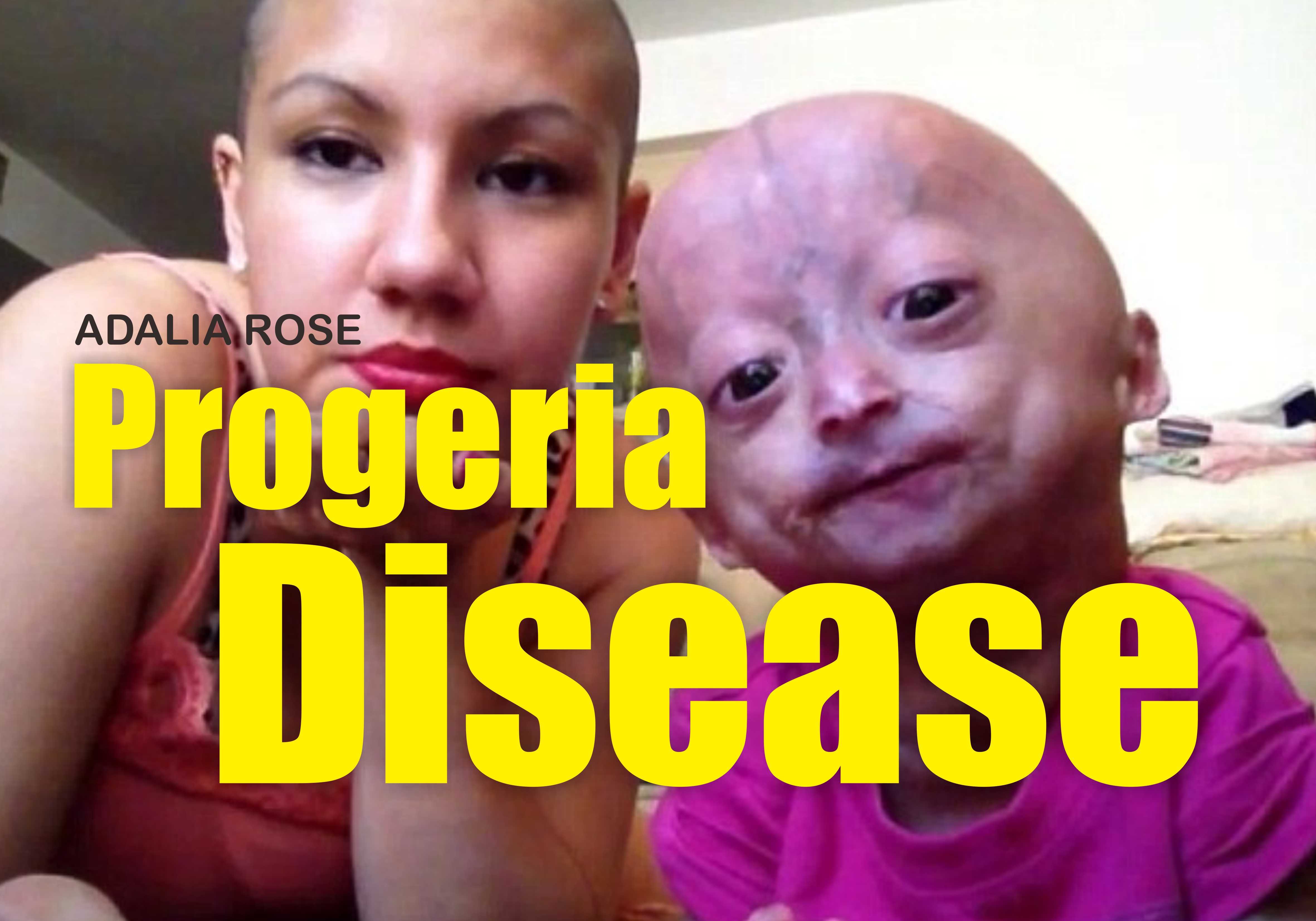 Adalia Rose Patients Of Progeria