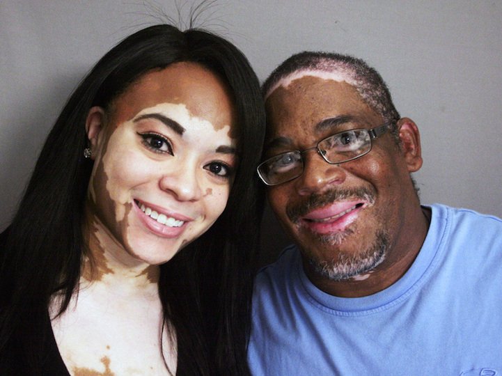 My theory on the cause of my Vitiligo. Serious critique by 