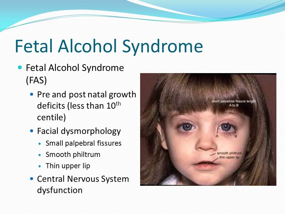 fetal alcohol syndrome diagnosis