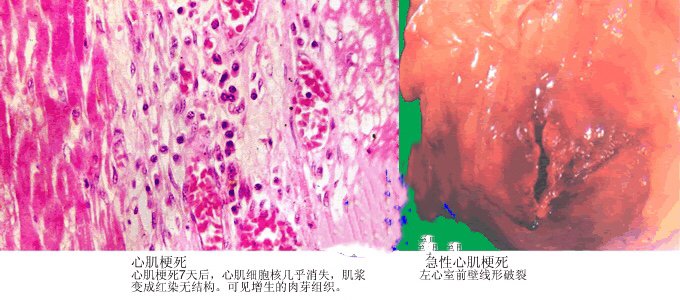 图片来自病理学园地