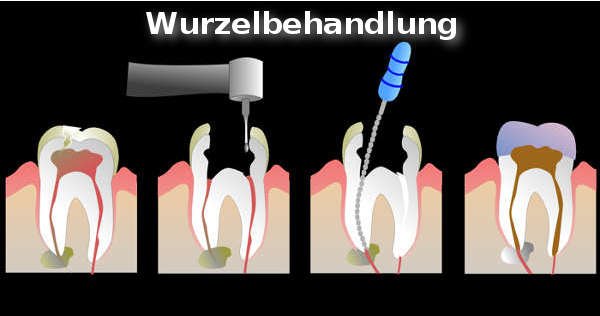 Eine Wurzelbehandlung.