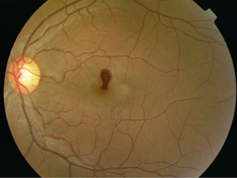Valsalva Induced Parafoveal Hemorrhage Credit Valsalva Induced Parafoveal Hemorrhage Credit