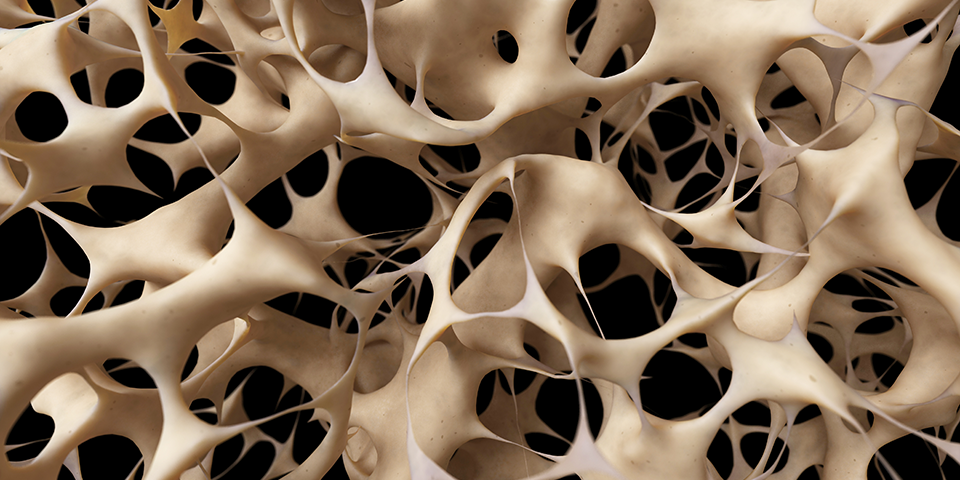 osteoporosis