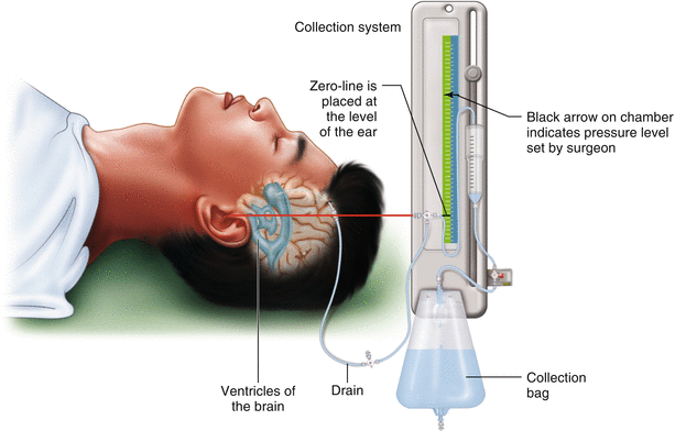 External Ventricular Drain Market.gif