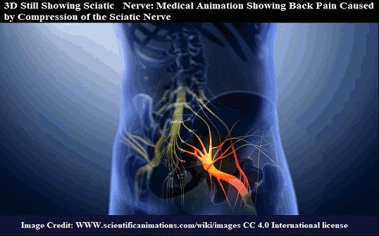compression2 of sciatic gif 2nerve www scientificanimations.com wiki  images  4.0.gif