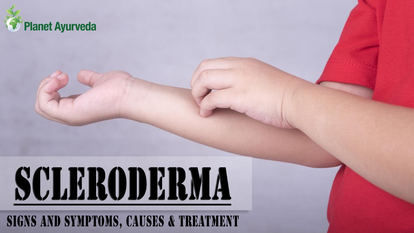 2019 year - Scleroderma – Types, Symptoms, And Causes Natural Treatment Options 2019 year
