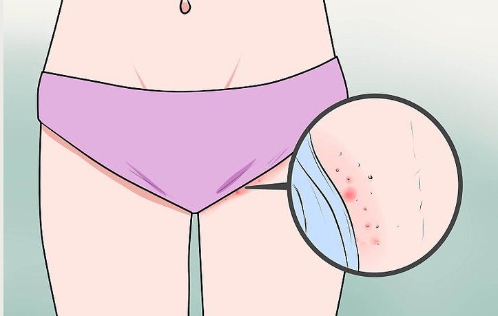 Vulva cancer symptoms and side effects galleries 47
