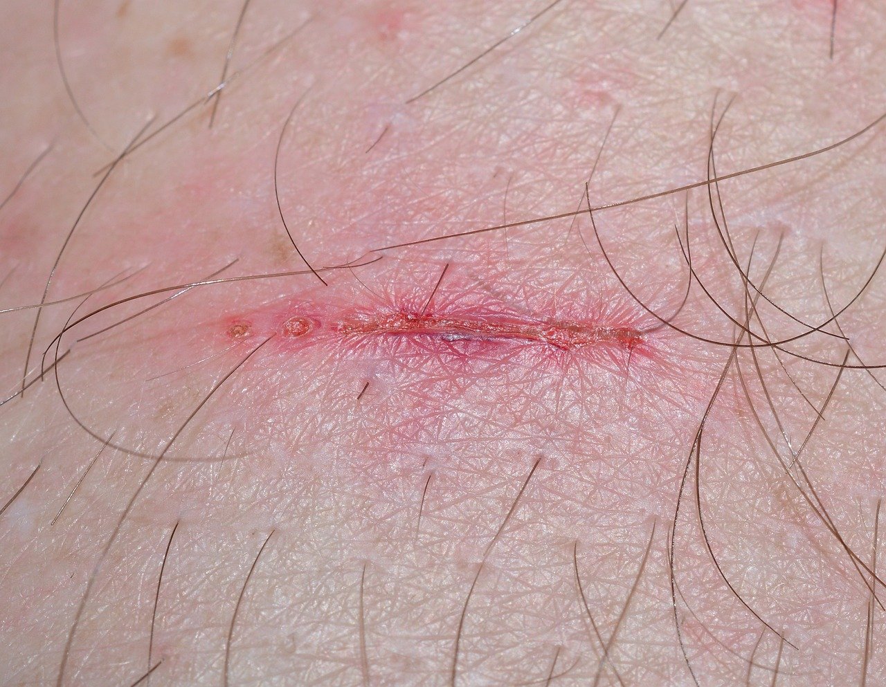 wound-321361_1280.jpg