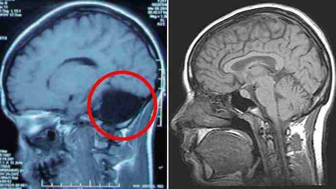 woman-with-no-cerebellum.jpg