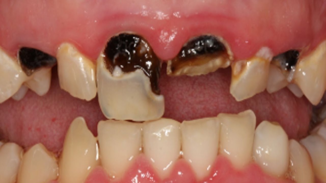 Resultado de imagen para caries dental