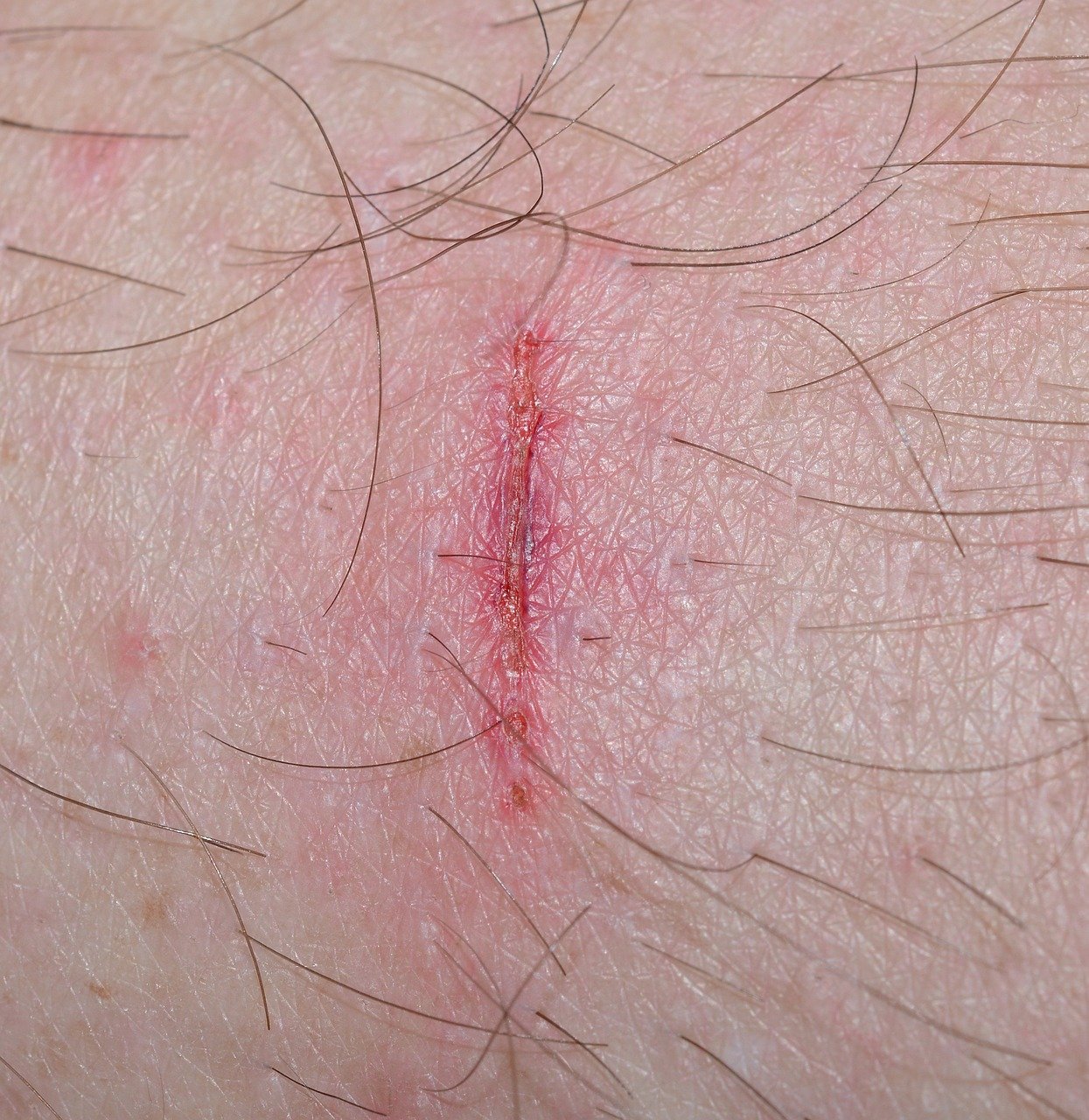 wound-321362_1280.jpg