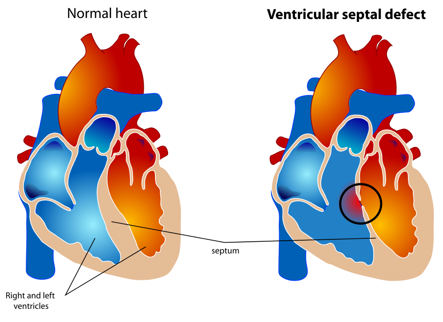 The Blue Baby Syndrome Introduction Management Of The Tetralogy Of 