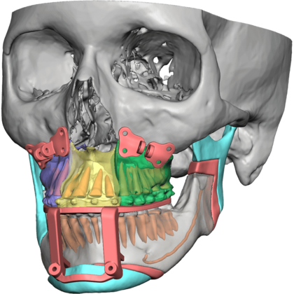 3d-systems-vsp-orthognathics-hero.png
