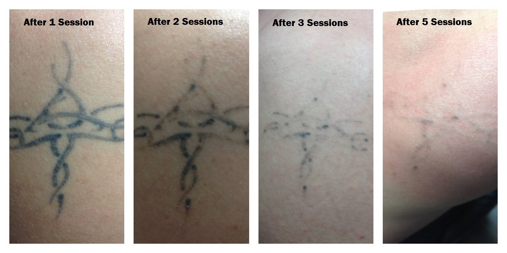 The Second Thing That Will Determined How Many Sessions Your Tattoo Will Need For Removal Is Going To Be What Colors The Pigments Are The Second Thing That Will Determined How Many Sessions Your Tattoo Will Need For Removal Is Going To Be What Colors The Pigments Are
