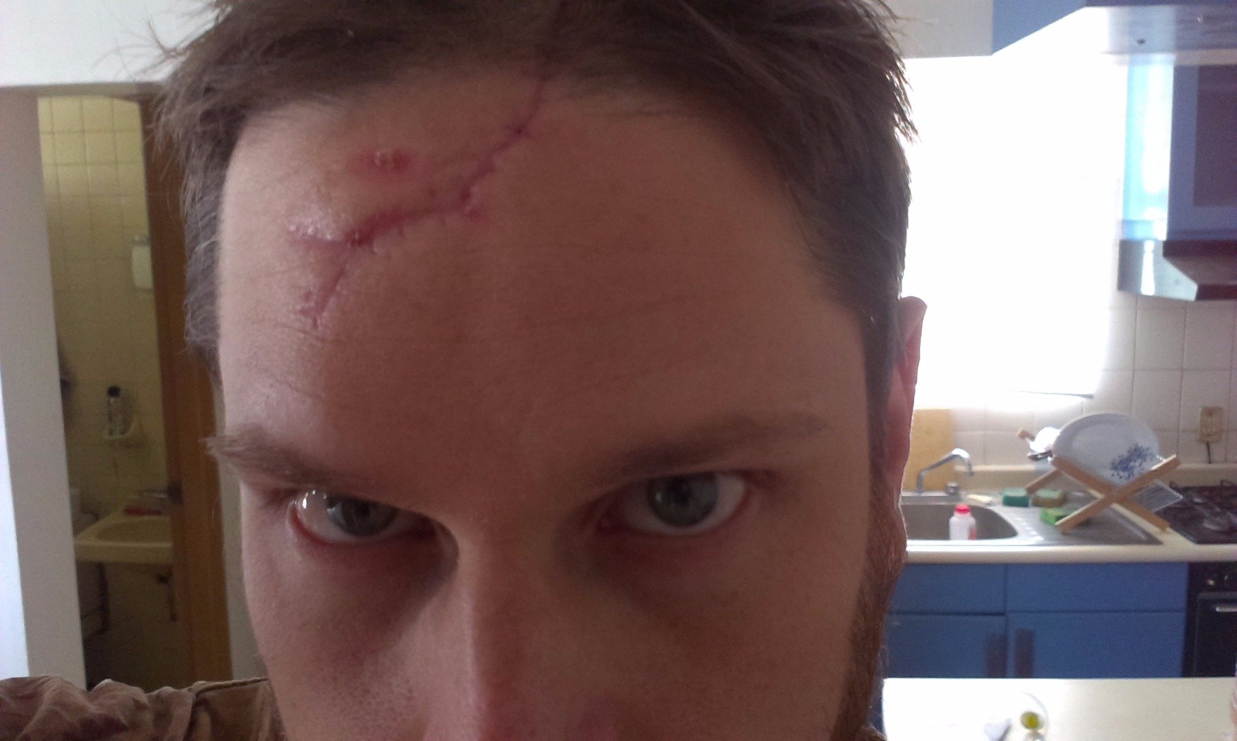 My forehead with a large forked scar with many stitchmarks