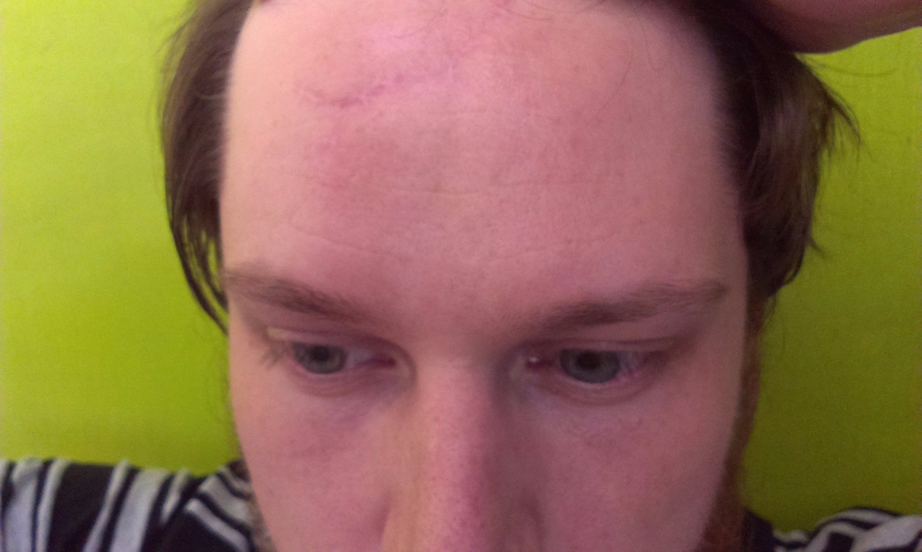 My forehead with a much less visibile scar