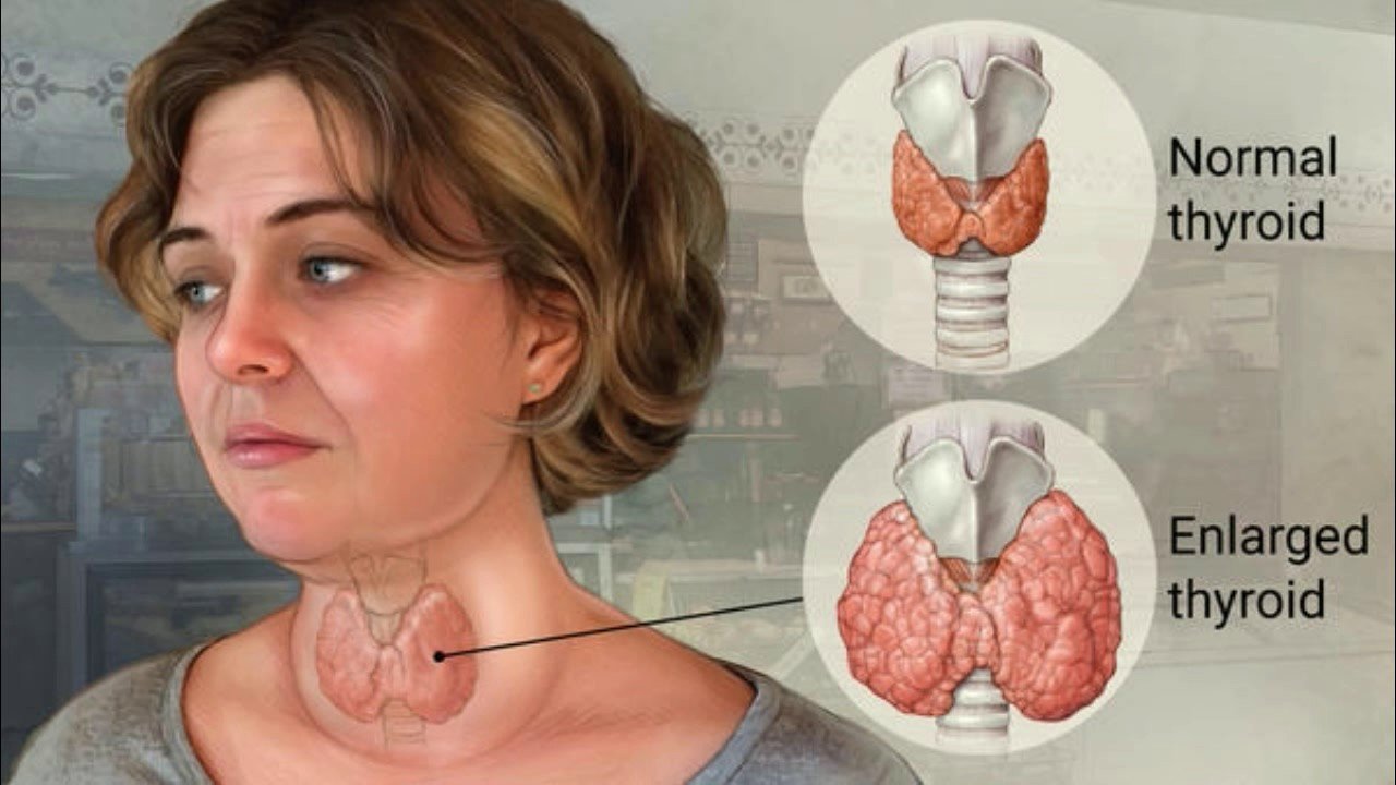 goiter