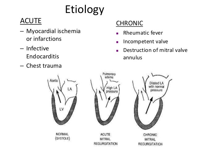 Valvular Heart Disease What is it (Part 2 Mitral