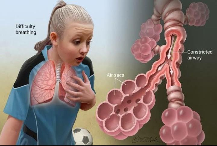 Asthma;Symptoms, Causes and Remedies — Steemit