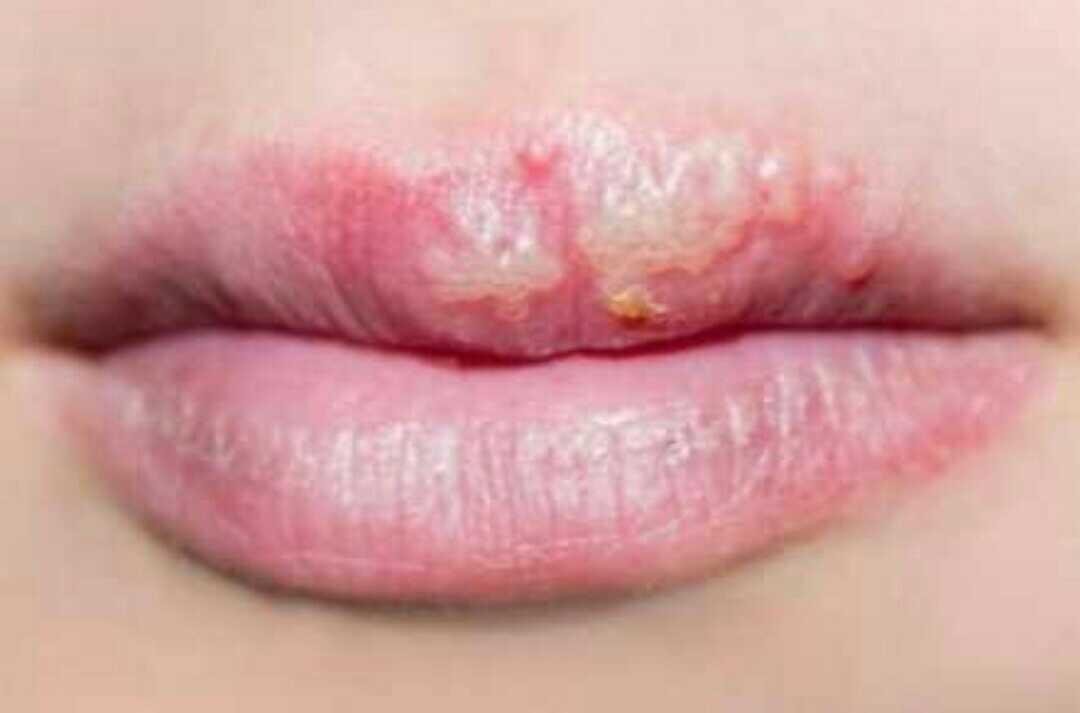 what-causes-white-patches-on-lips-lipstutorial