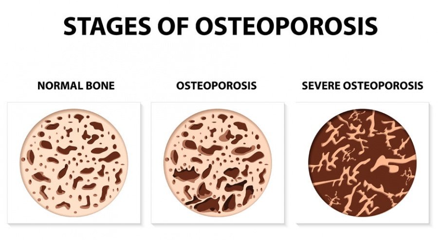 osteoporosis