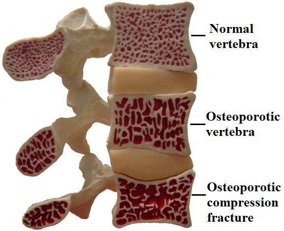 osteoporosis_steps_en.gif