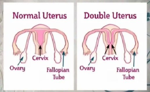Pics of woman with 2 vaginas