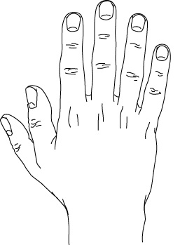 Polydactyly_preaxial.gif