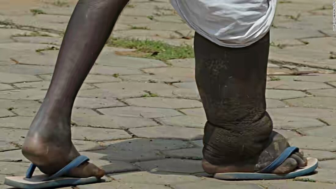 Download Mosquito; The cause of Elephantiasis — Steemit
