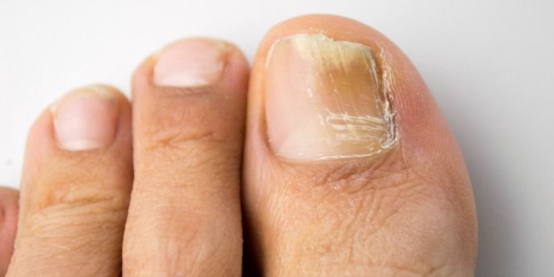 Vicks vaporub for toenail fungus.jpg