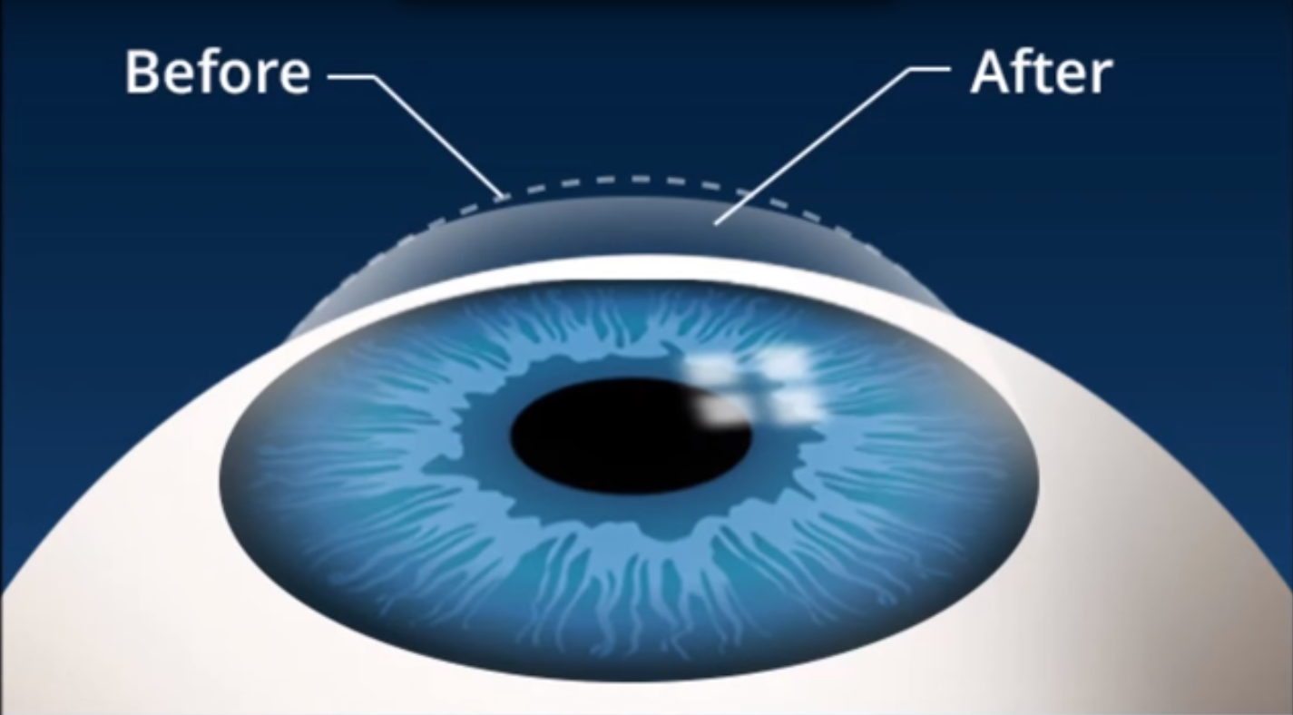 health and well being what is lasik miracle eye surgery gave me how lasik surgery works