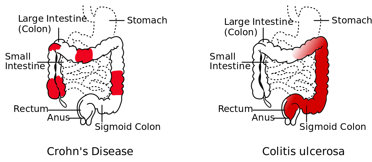 Crohn's_Disease_vs_Colitis_ulcerosa.svg.png