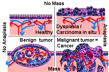 beningn tumors.gif