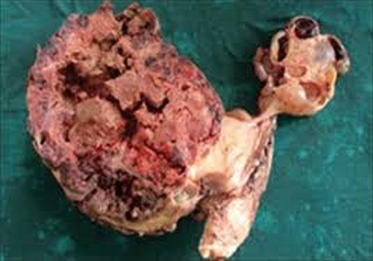 Choriocarcinoma-in-the-ovaries.jpg