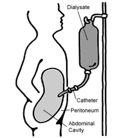 250px-Peritoneal_dialysis.gif