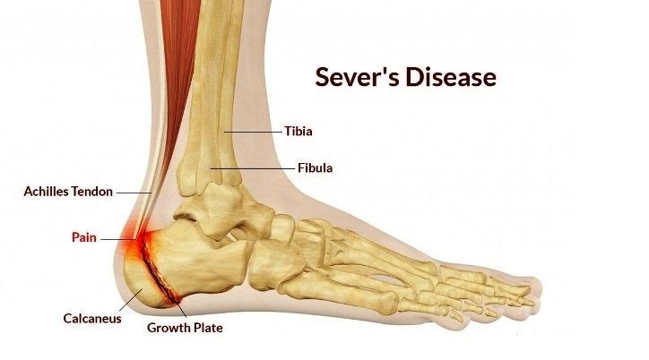 Sever-Disease-1024x599.jpg