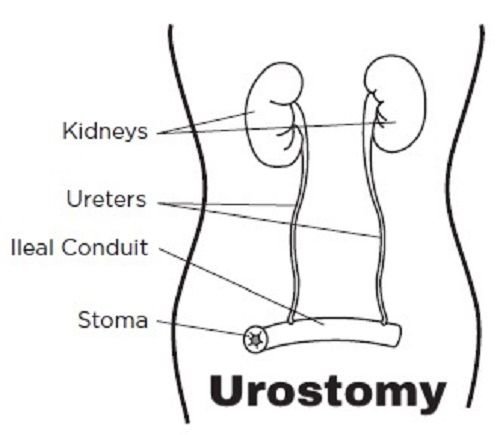 Urostomy.jpeg