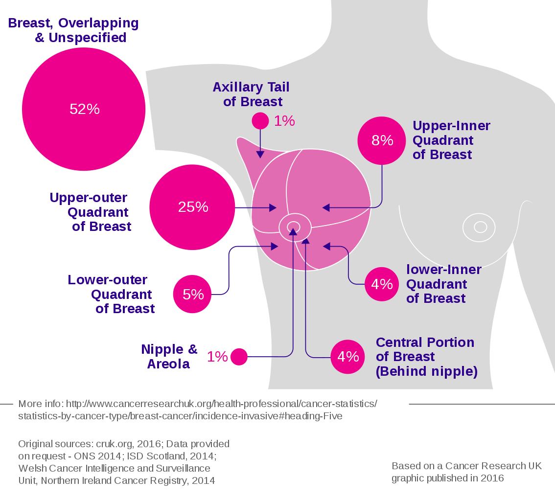 Breast cancer, its symptoms and treatment methods Breast cancer, its symptoms and treatment methods