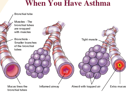 asthma-pictures11.gif