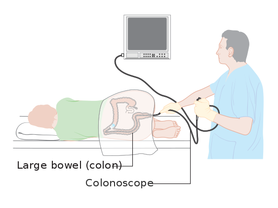 563px-Diagram_showing_a_colonoscopy_CRUK_060.svg.png