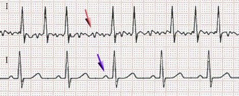 Afib_ecg.jpg