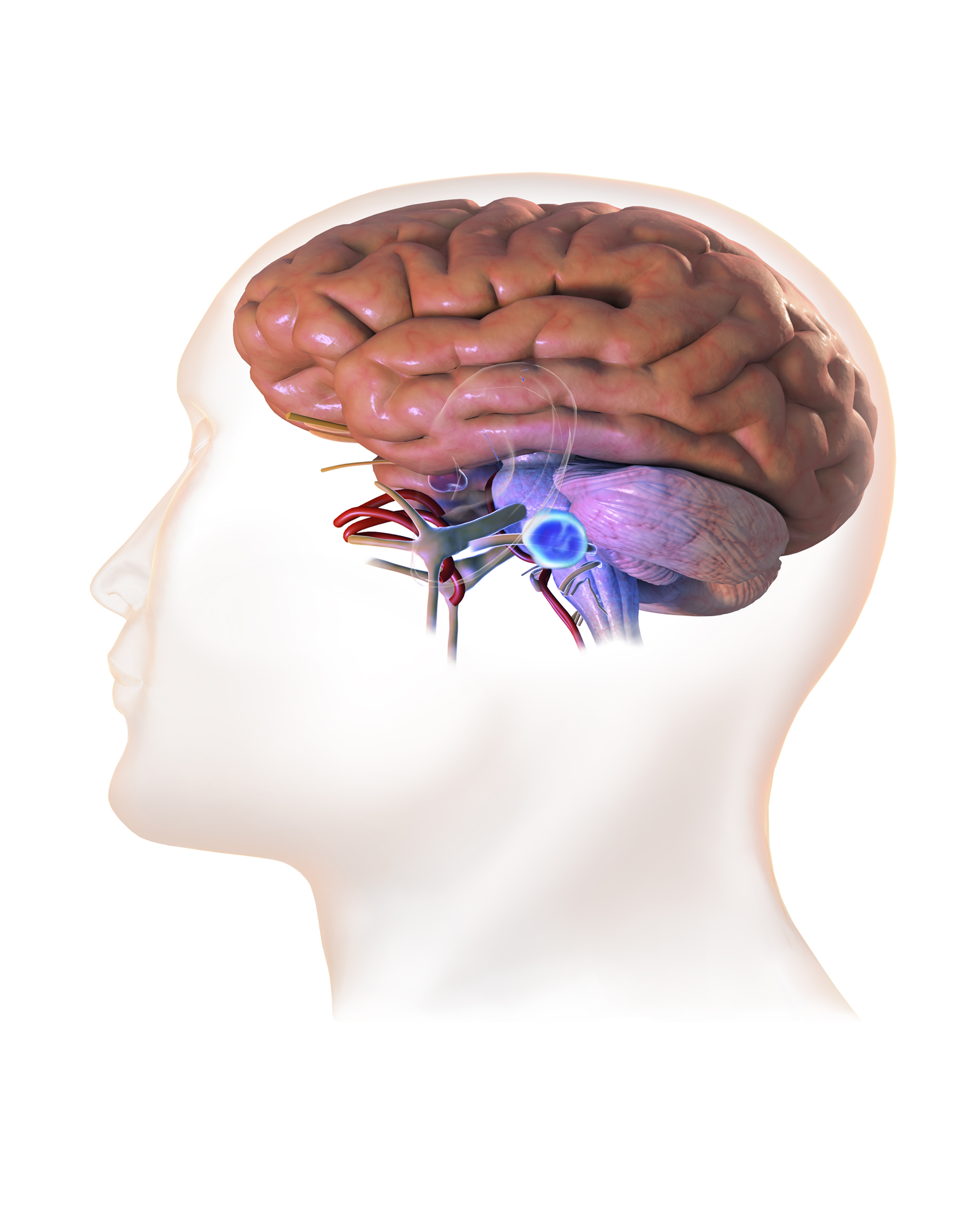 Vestibular Schwannoma