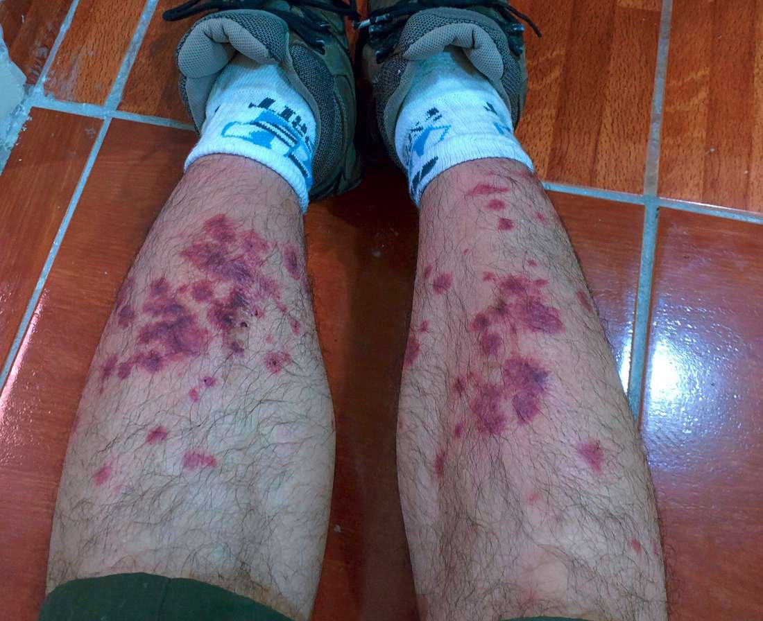 Attack of the Machu Picchu sand flies day 2