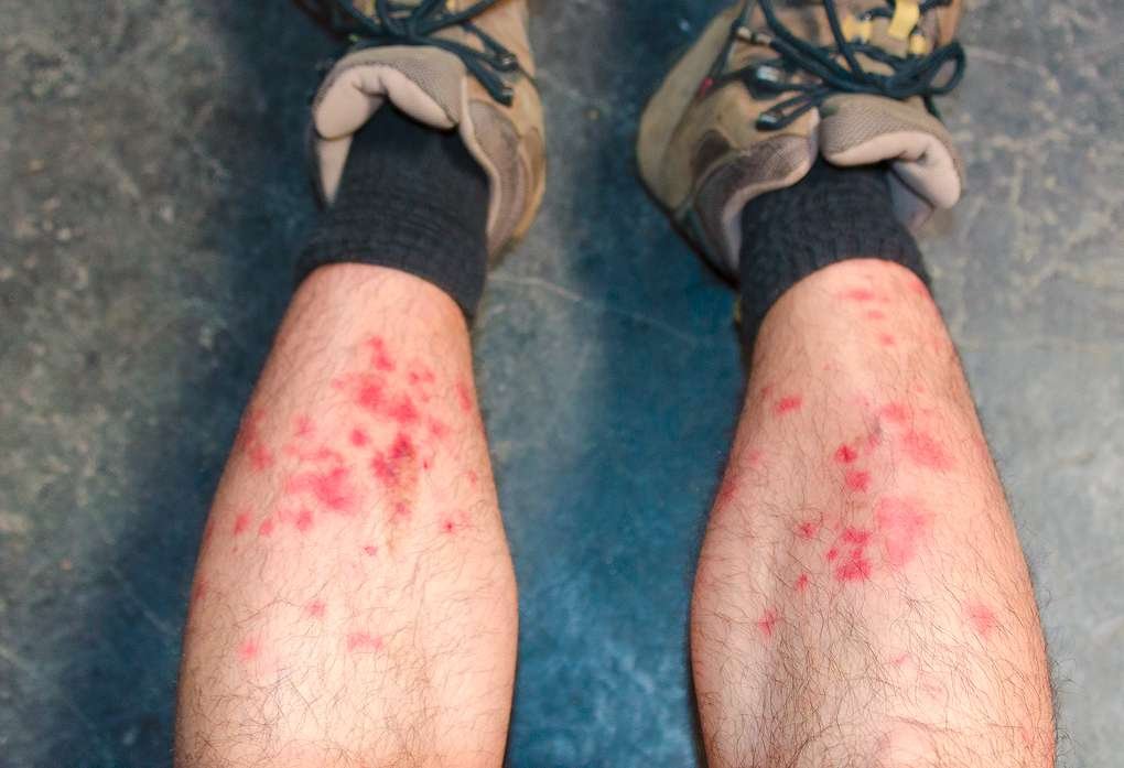 Attack of the Machu Picchu Sand Flies day 1