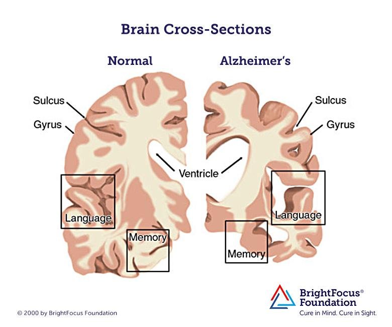 Alzheimer's disease | Is this the brain's ultimate fate ...