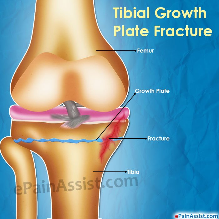 growth plate fracture